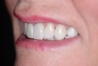 Smile profile view after full mouth rehabilitation — restored tooth length with E.max...
