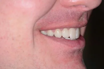 Smile profile view after porcelain veneers — restored tooth length and natural proportions