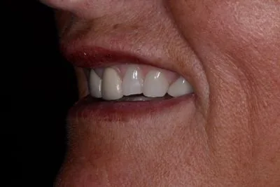 Smile profile view before full mouth rehabilitation — worn shortened teeth and collapsed...