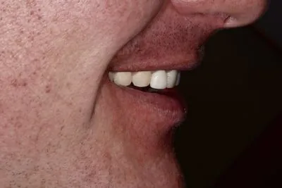 Smile profile view before porcelain veneers — worn shortened teeth from bruxism grinding