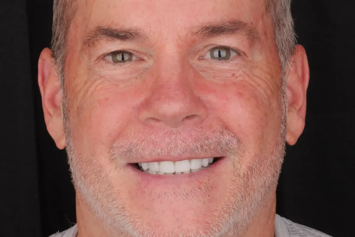 Steve's Case after veneers