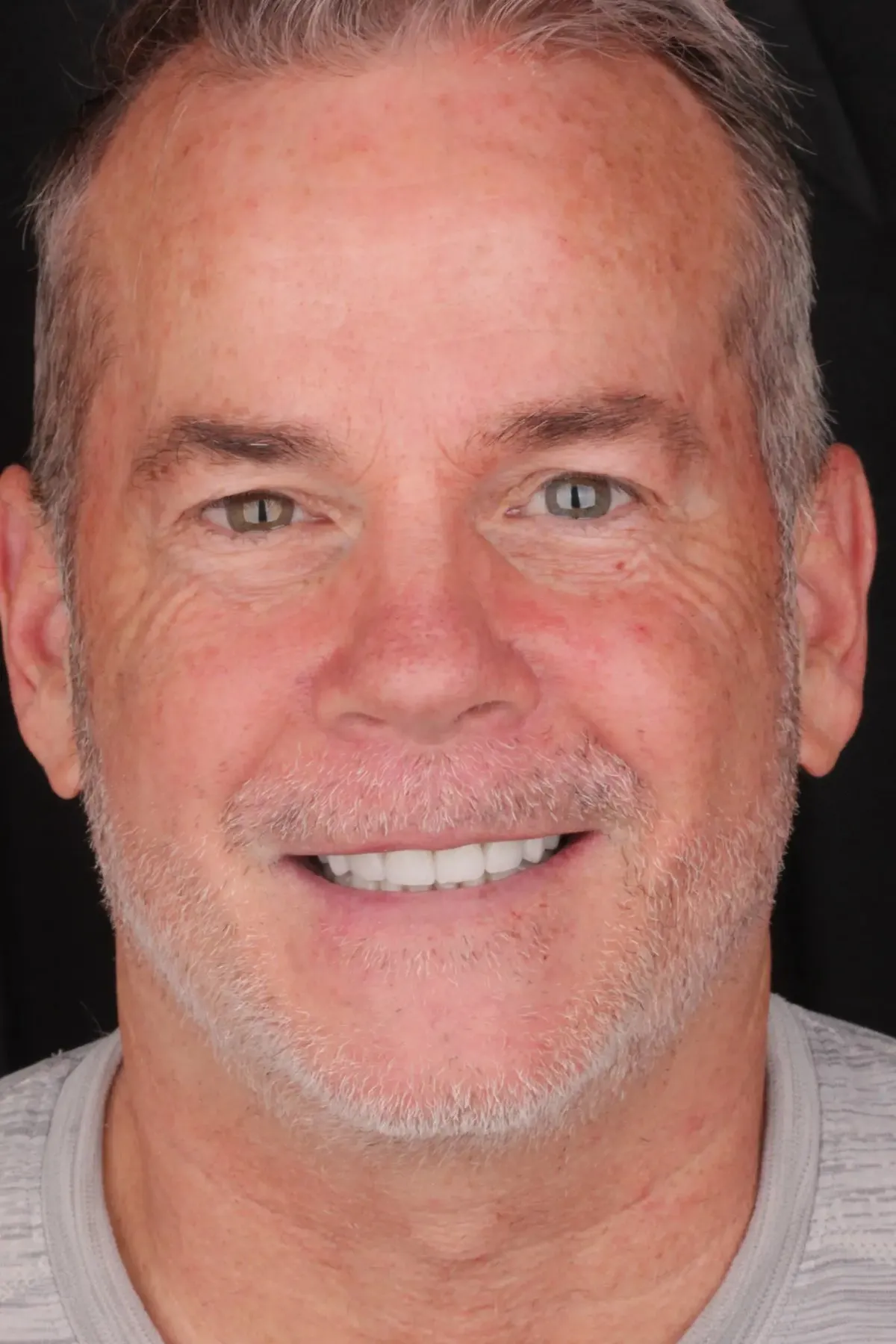 Steve after 14 E.max veneers in shade B1 — full, bright, confident smile on both arches