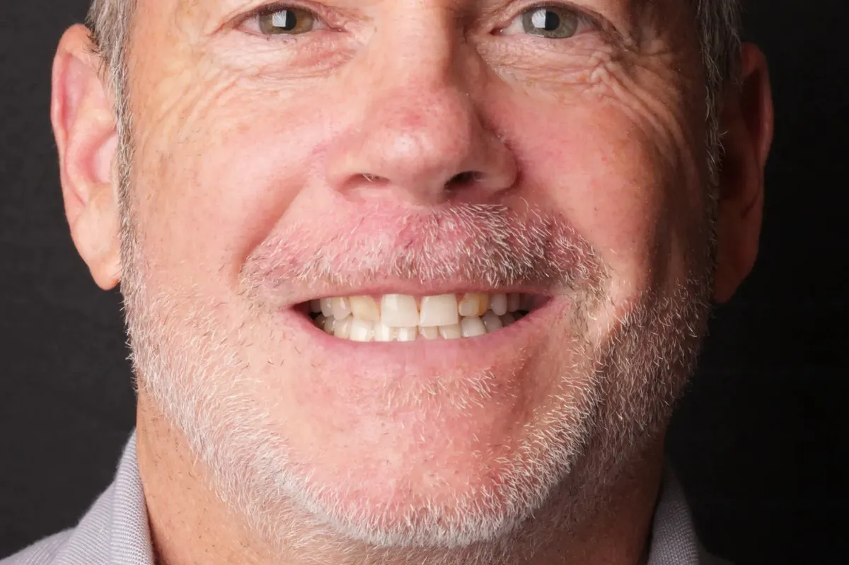 Steve before veneers — worn, short, crooked teeth barely visible when smiling
