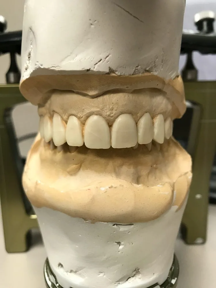 Temporary veneers on articulator during treatment planning