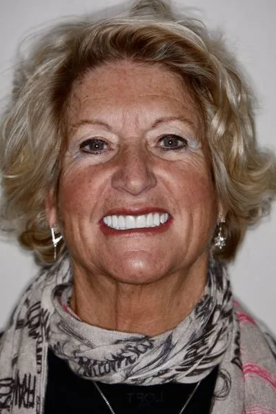 Temporary veneers during full mouth rehabilitation — provisional restorations verifying bite...