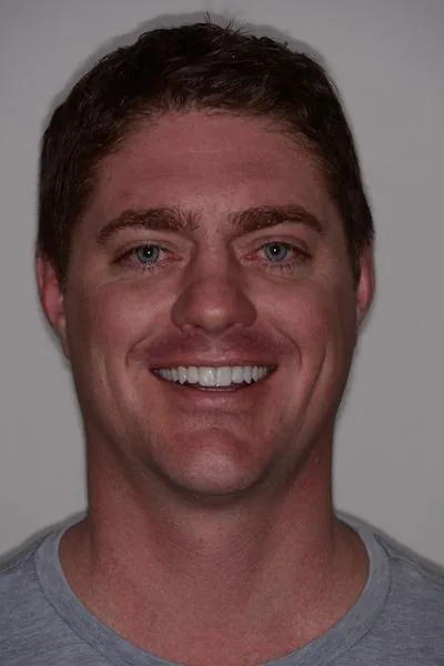 Temporary veneers and provisional restorations during full mouth porcelain veneer treatment...