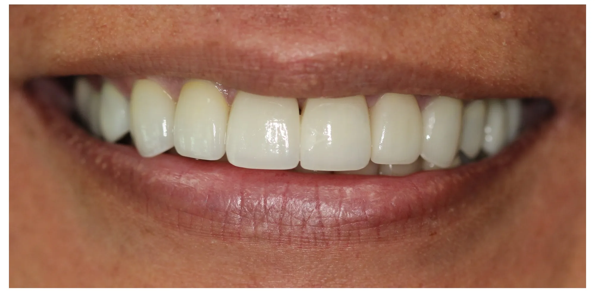 Tricia after veneers and crowns