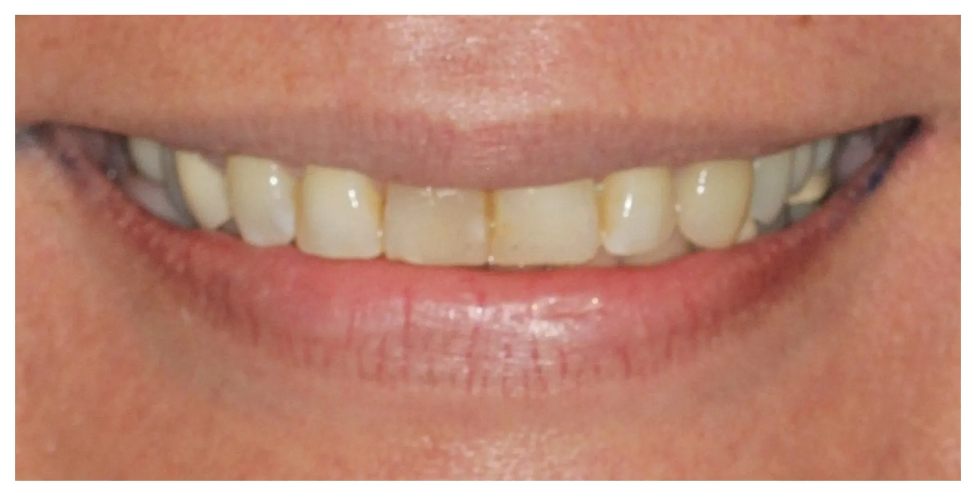 Tricia before veneers