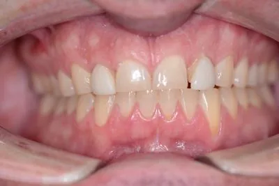 Worn teeth retracted clinical view before porcelain veneers — bruxism grinding damage and...