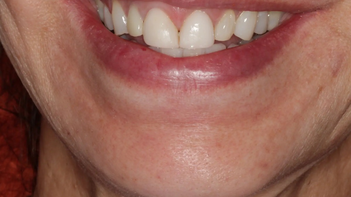 Smile makeover before