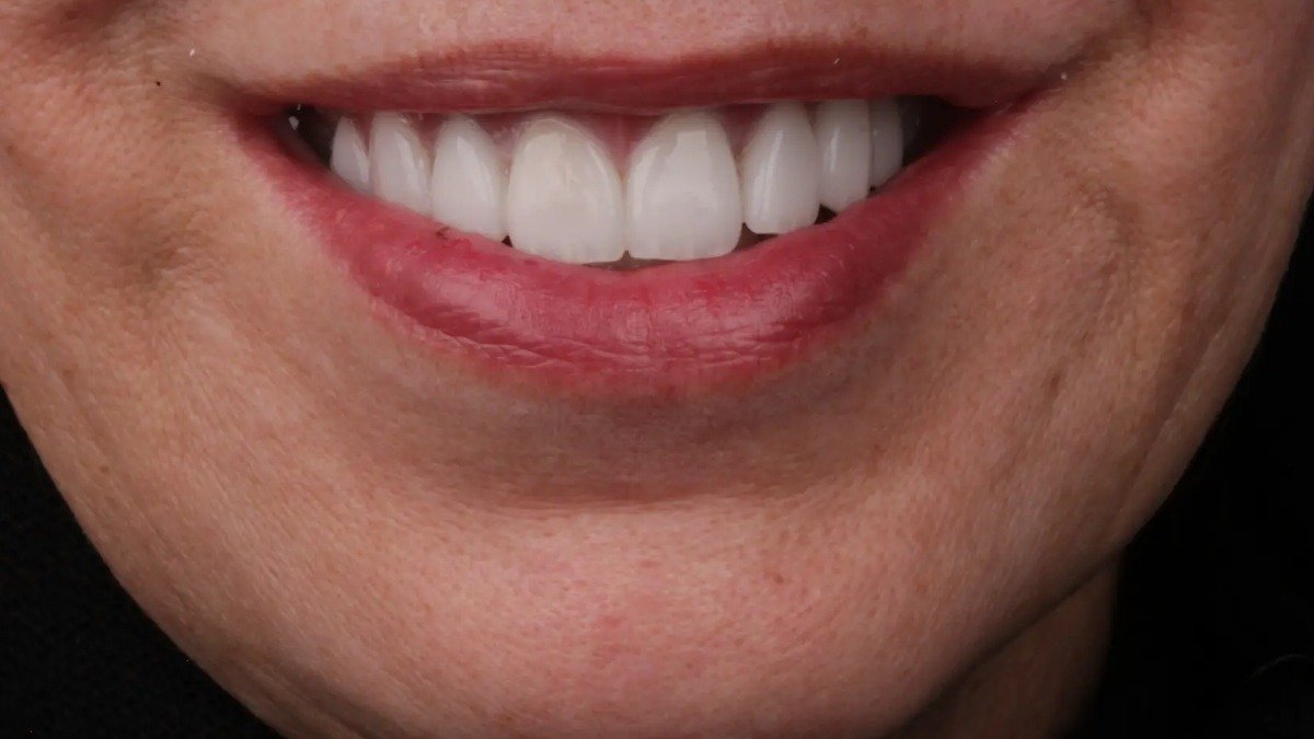 Danielle's Case after veneers