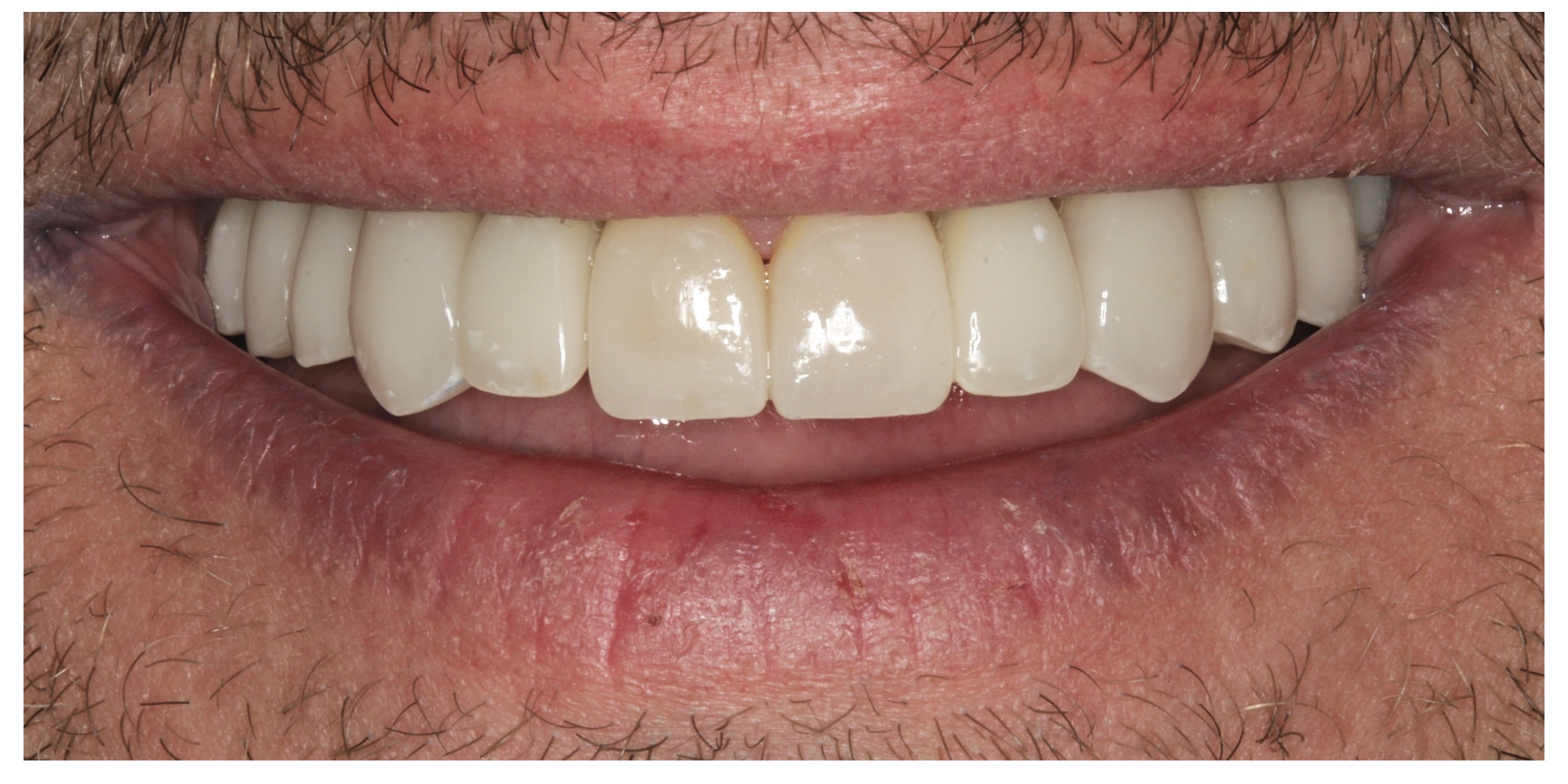 Smile transformation after veneers
