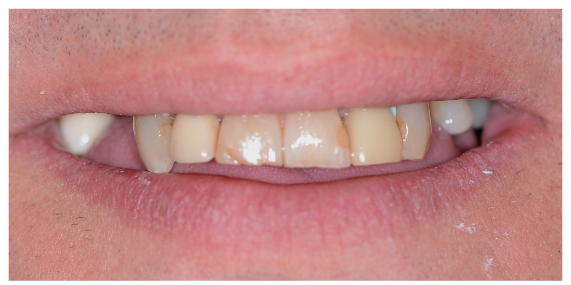 Smile transformation before veneers