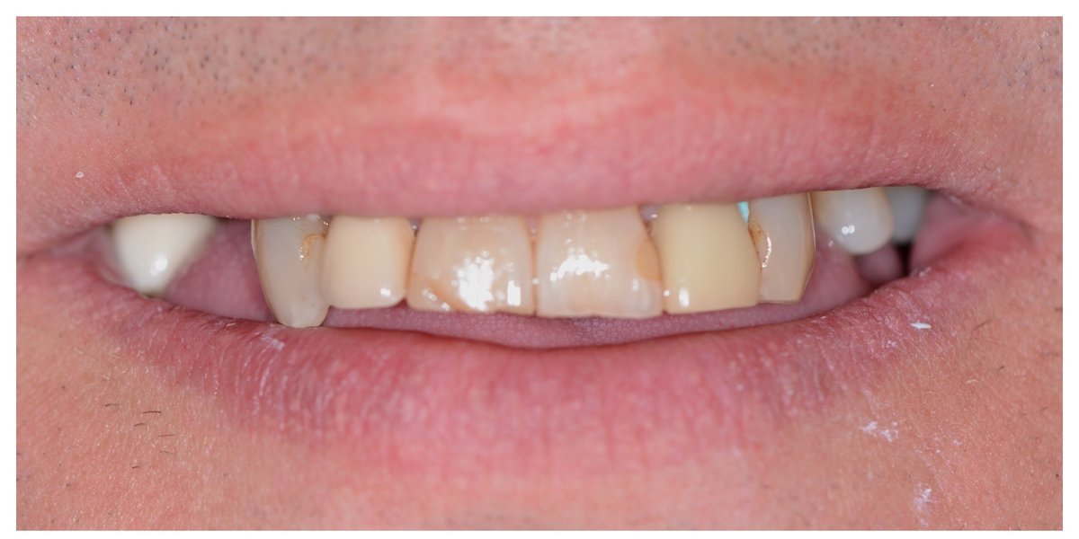 David's Case before veneers