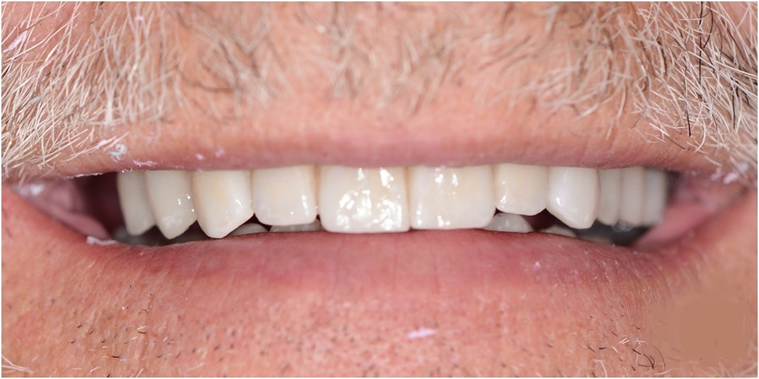 Full mouth reconstruction after