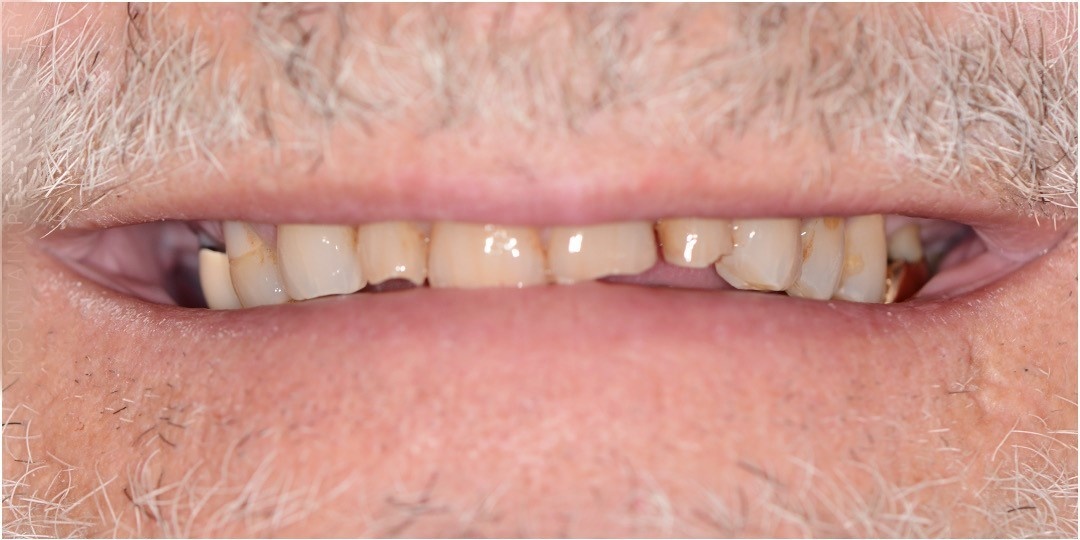 Full mouth reconstruction before