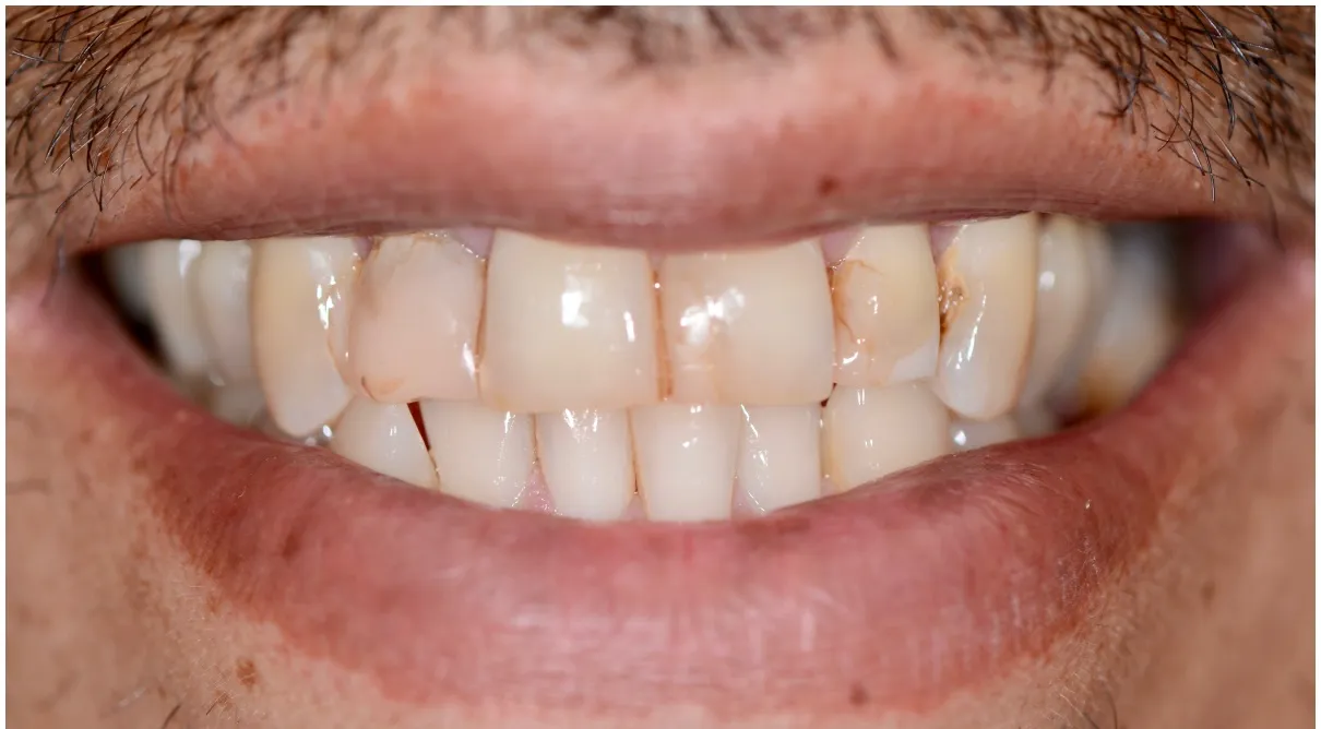 Jason's Case before veneers