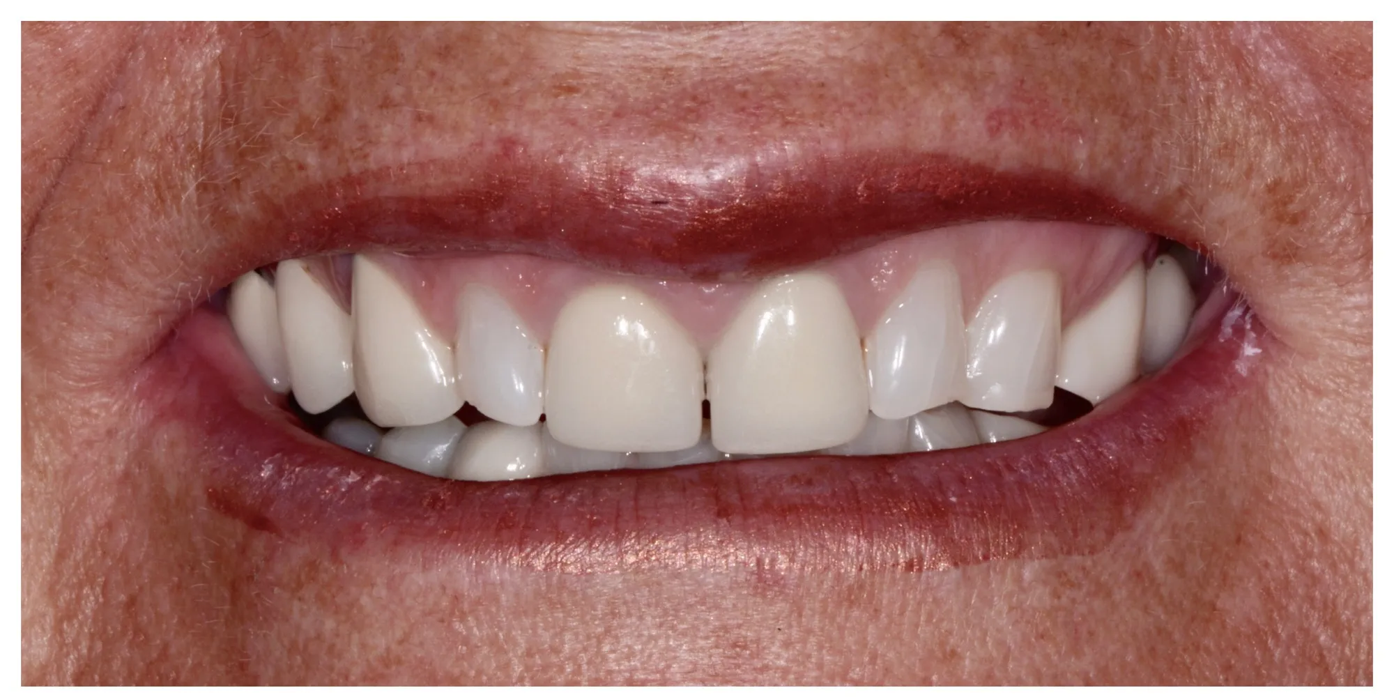 Joanne before full-mouth rehabilitation