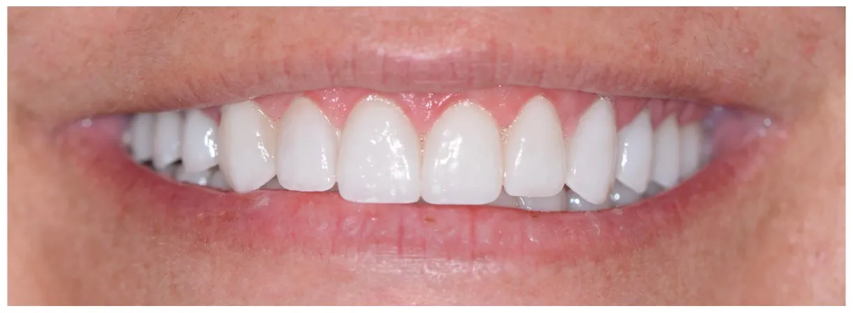 Nikki's Case after veneers