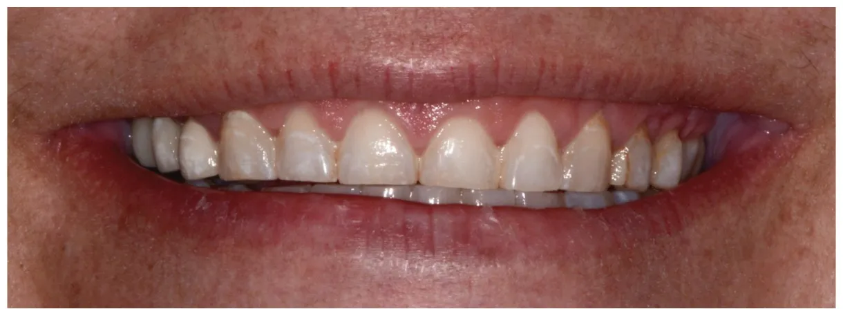 Nikki's Case before veneers