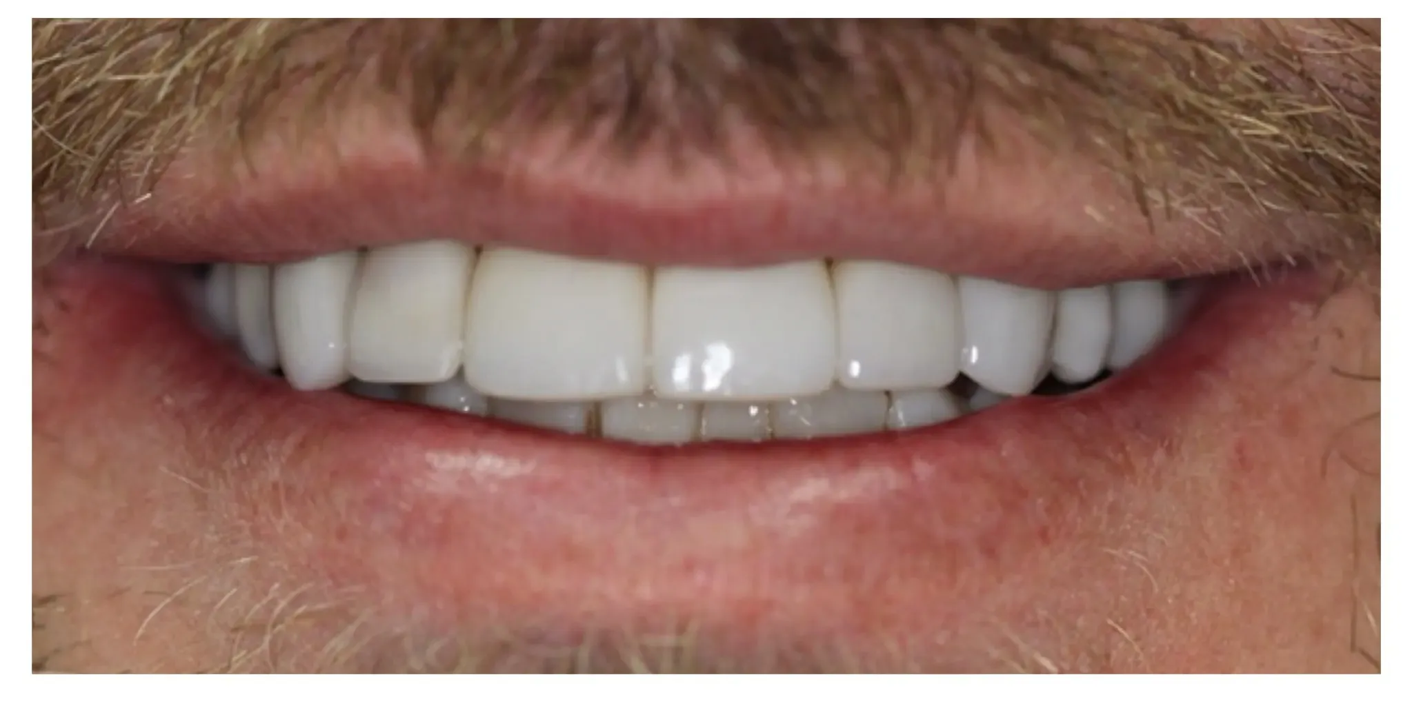 Ryan's Case — before and after veneer case