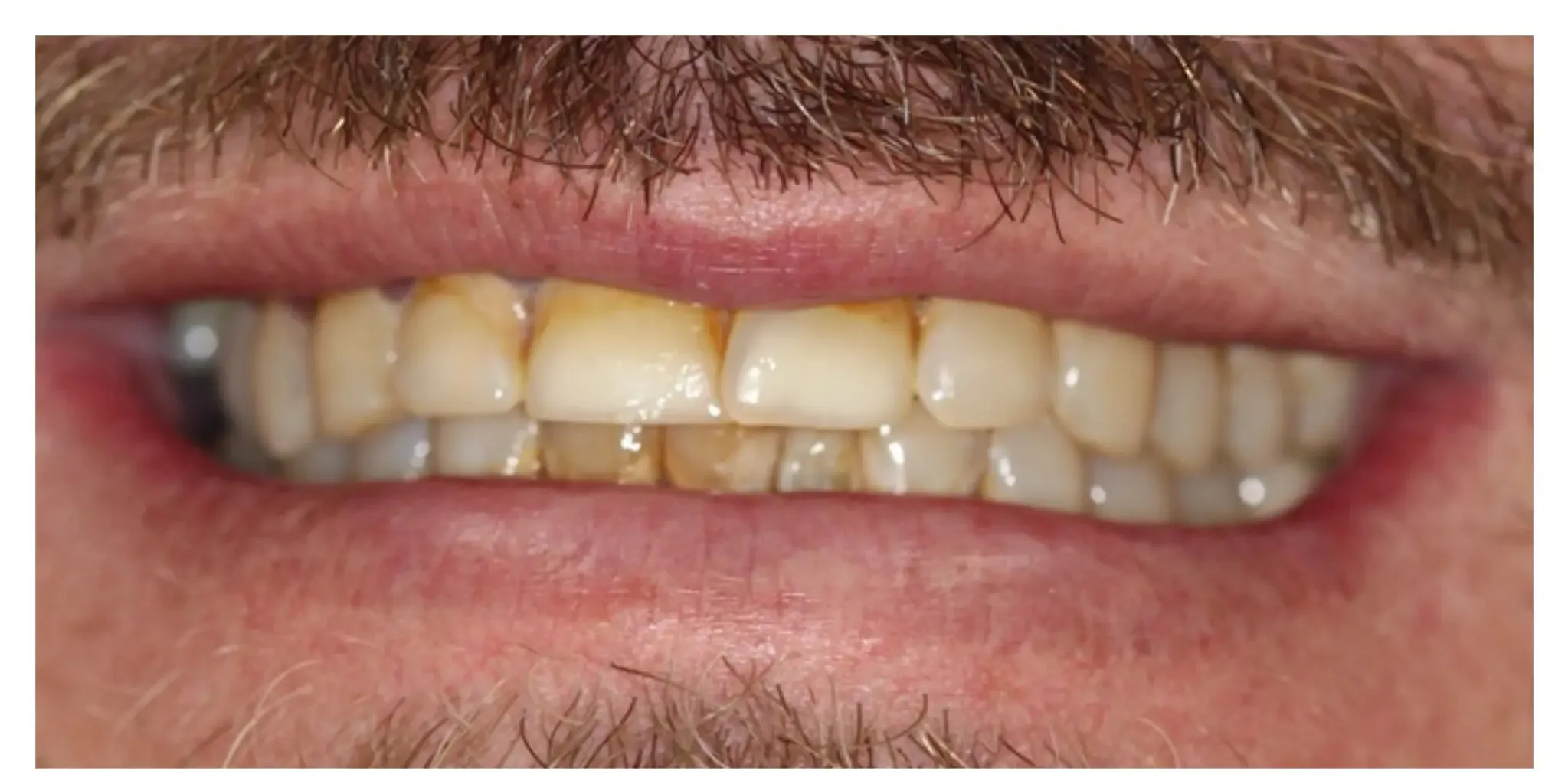 Joan's Case before veneers
