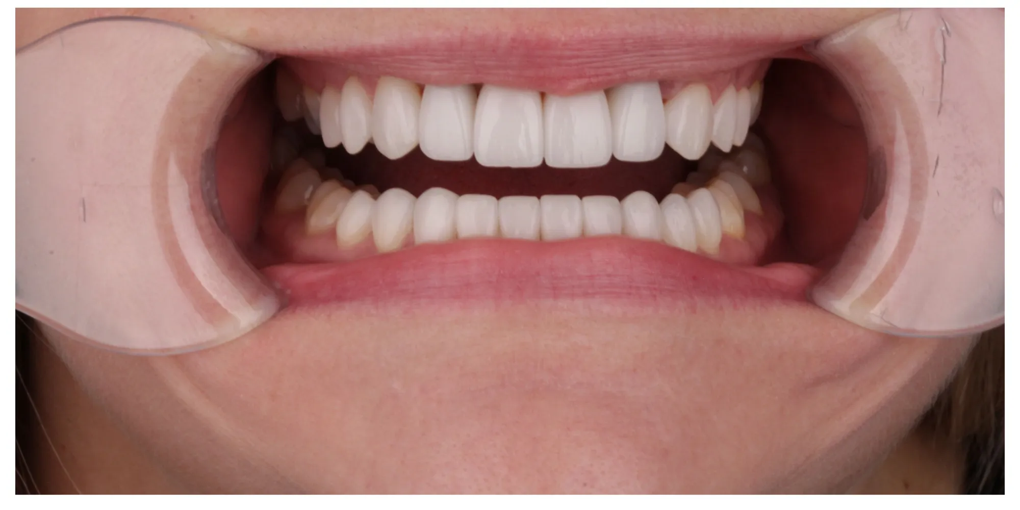 Sarah's Complex Case — veneers designed around existing implants