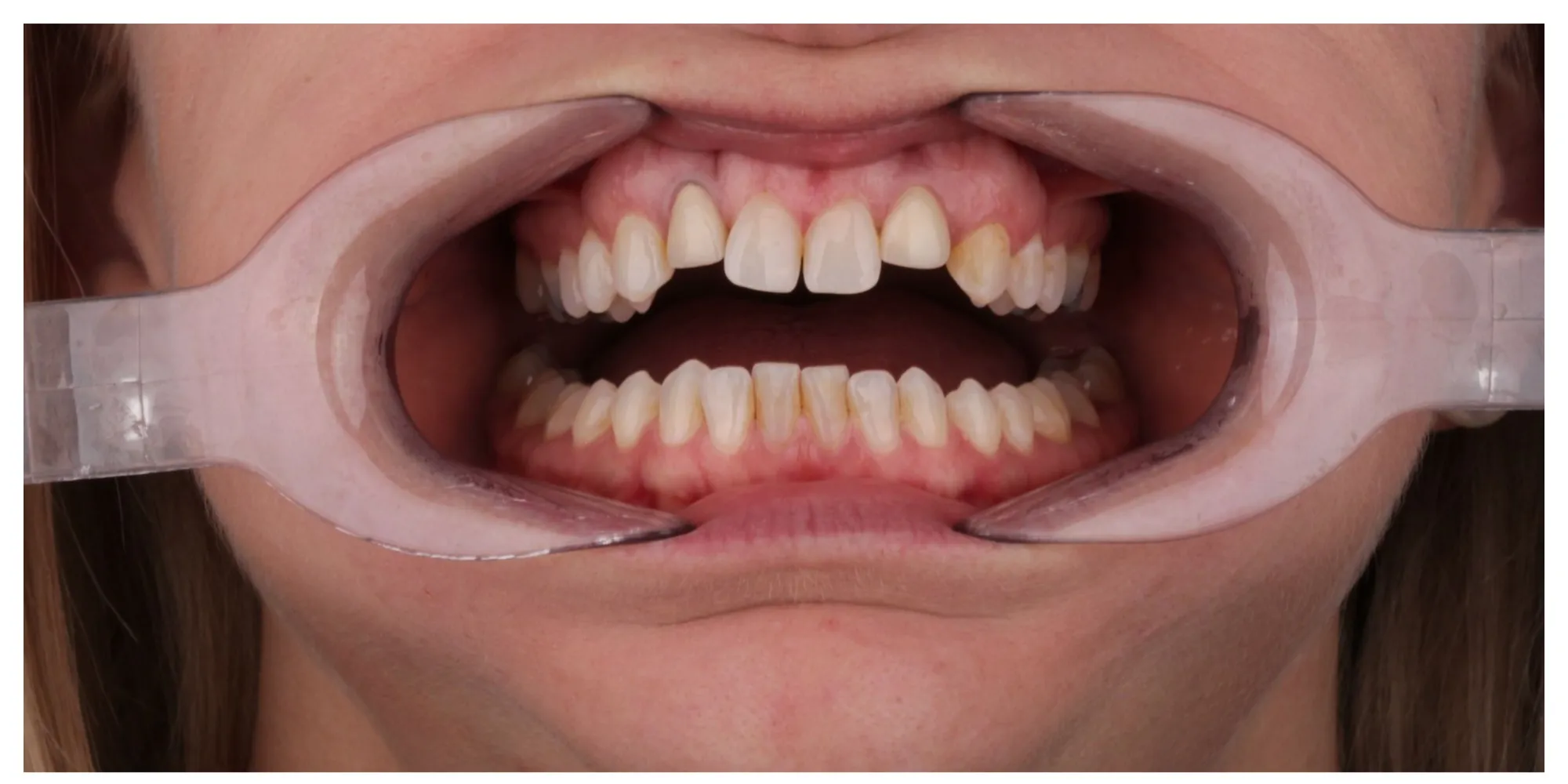 Sarah's Case before veneers