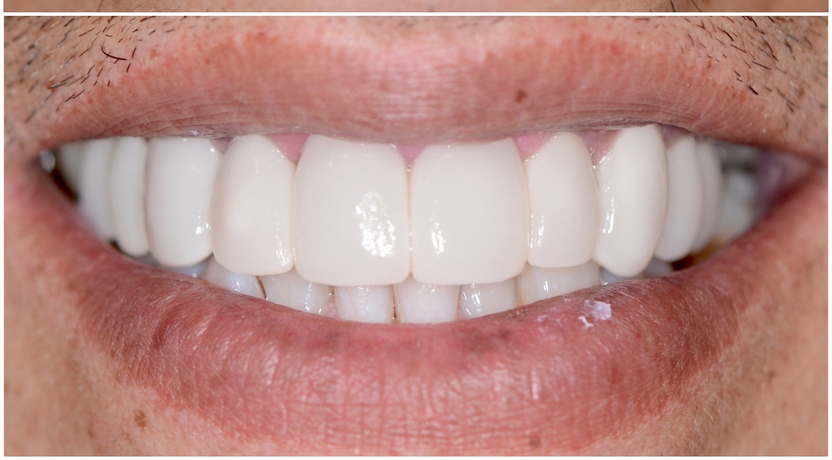 Full arch whitening after