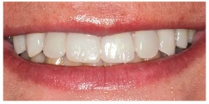 Alignment and whitening after veneers