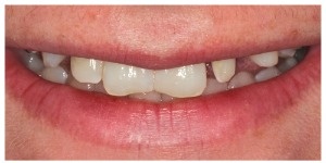 Alignment and whitening before veneers
