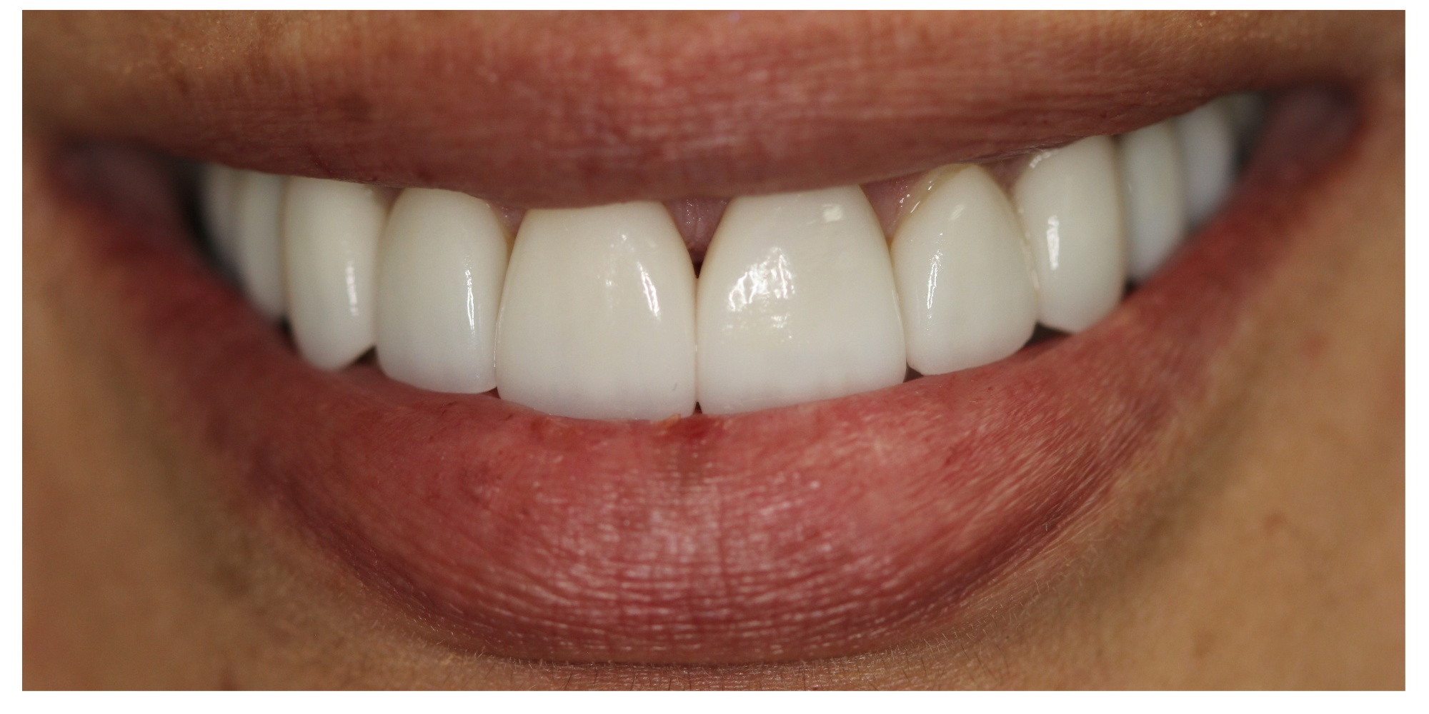 Smile brightening and shape correction after veneers