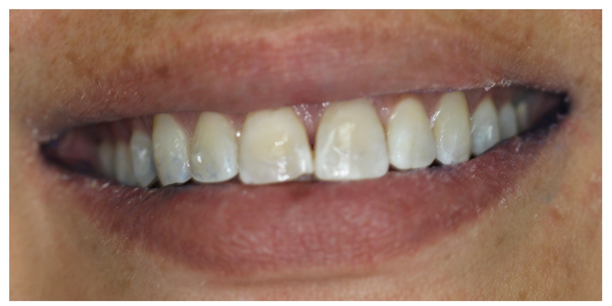Smile brightening and shape correction before veneers