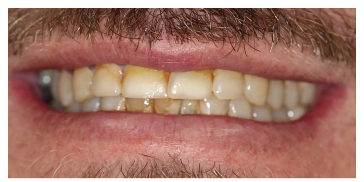 Tooth discoloration before porcelain veneer treatment