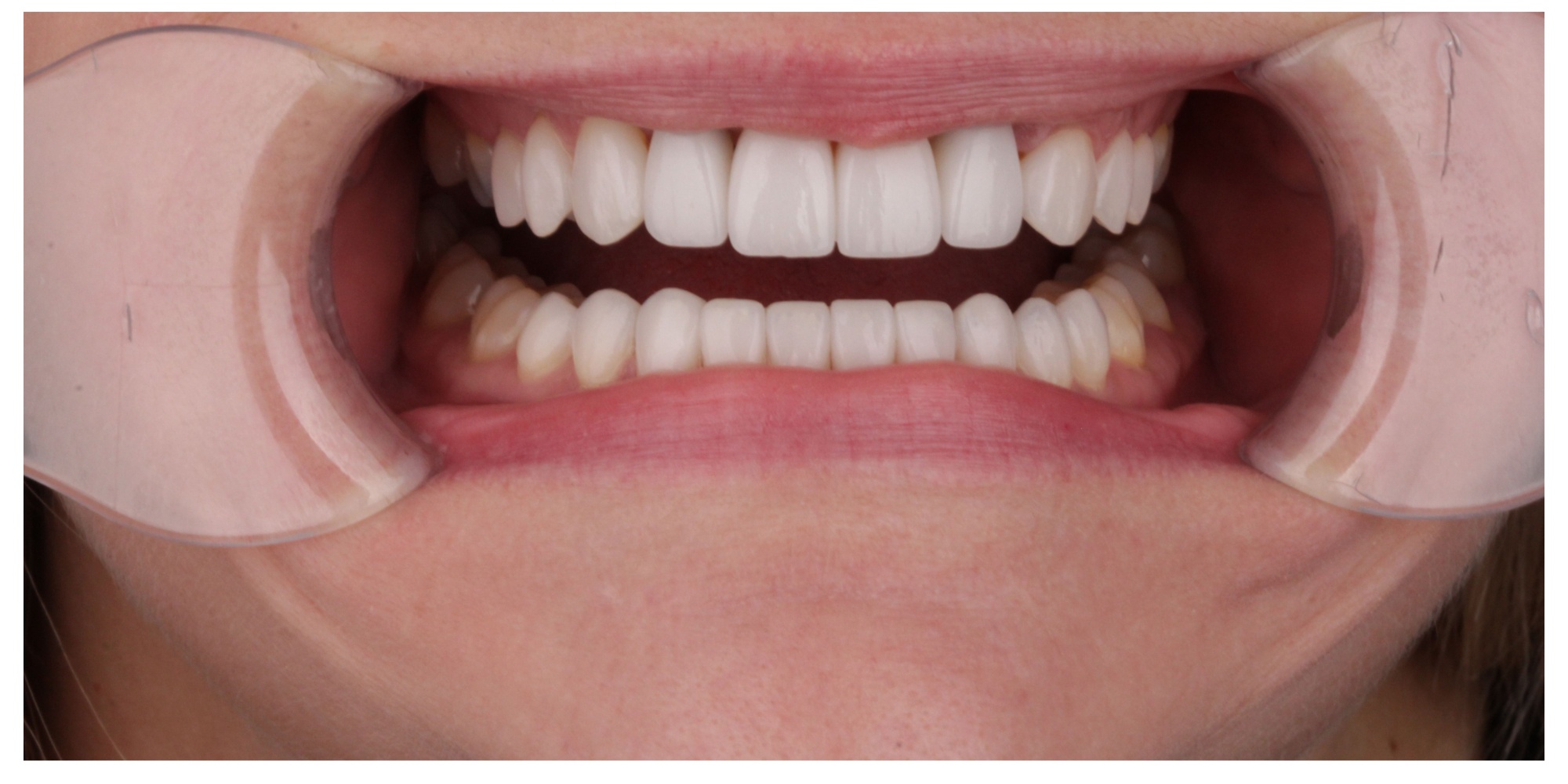 Full arch restoration after veneers