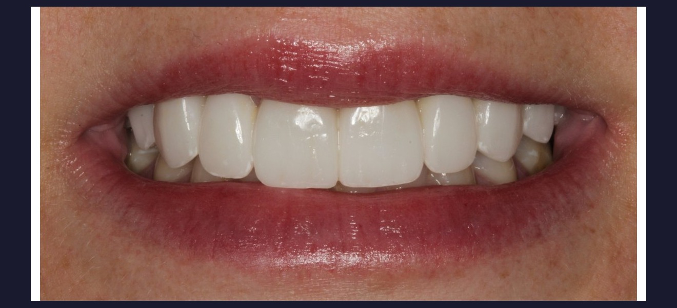 Full smile makeover after