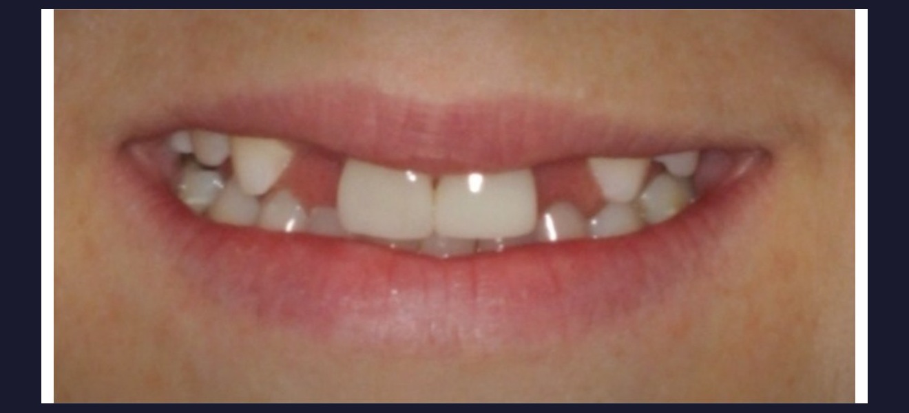 Full smile makeover before