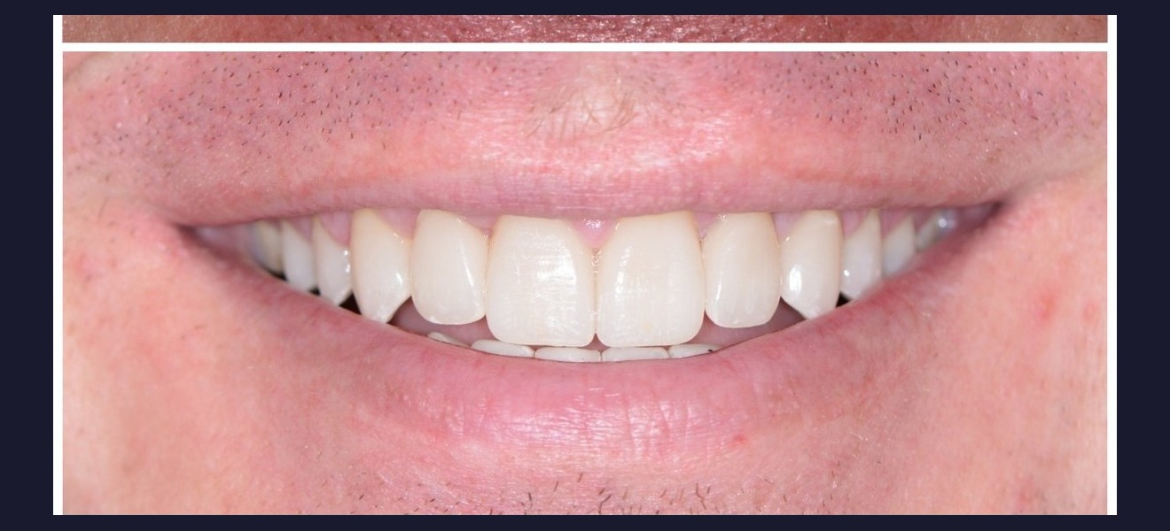 Gap closure after veneers