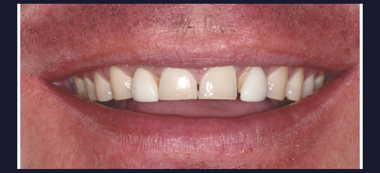 Gap closure before veneers
