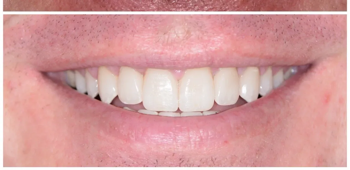 After veneers - Brandon