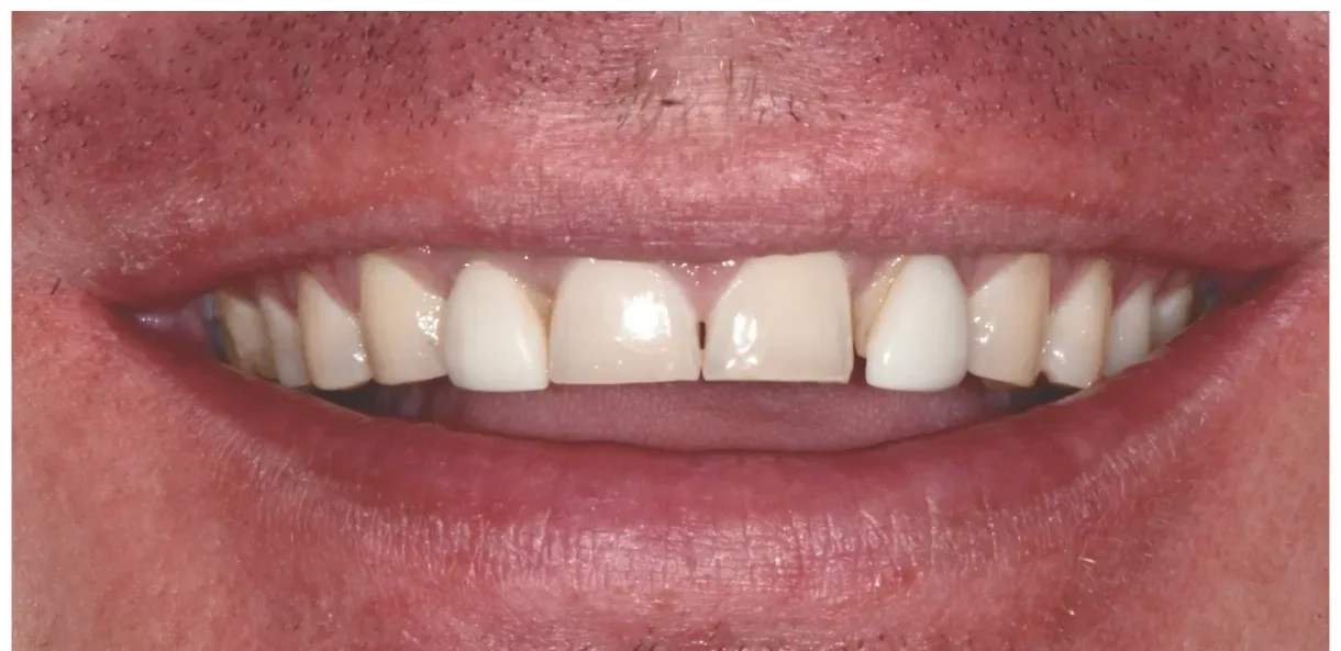 Before veneers - Brandon