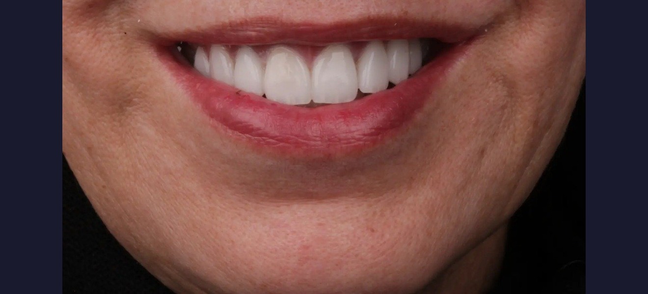 Smile makeover after