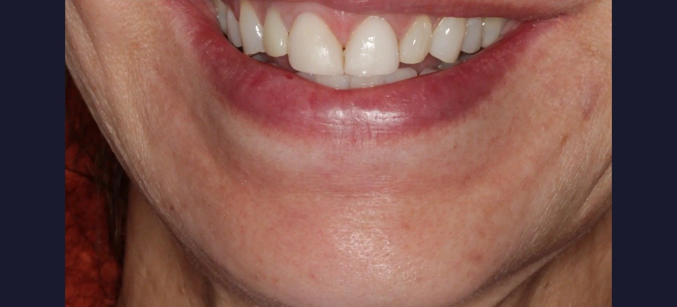 Smile makeover before