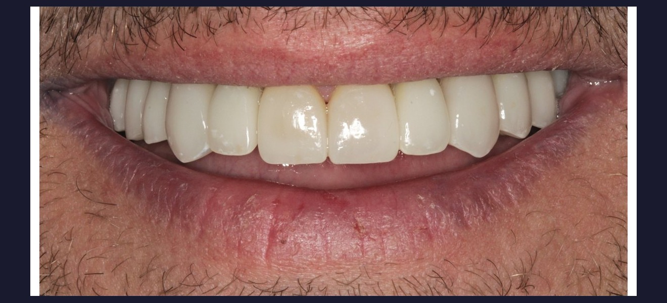Smile transformation after veneers
