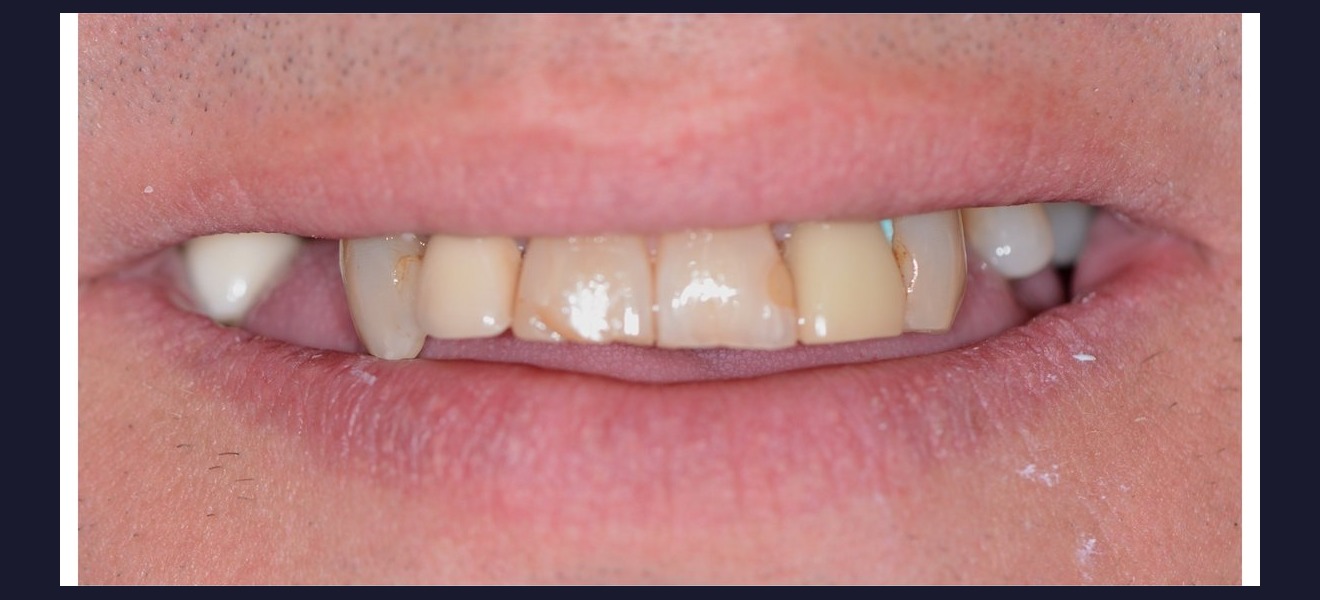 Smile transformation before veneers