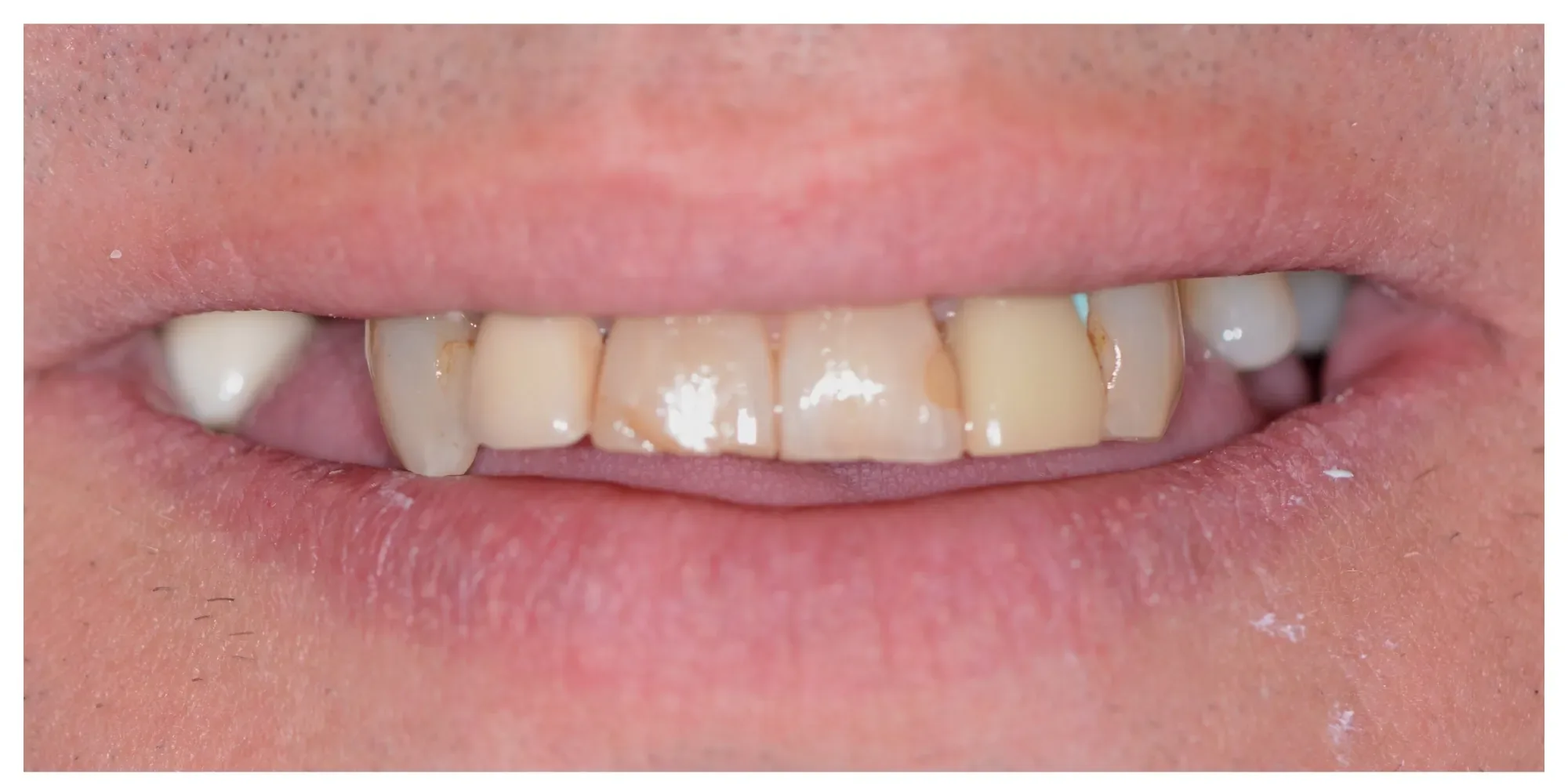 David's smile with missing and damaged teeth before reconstruction