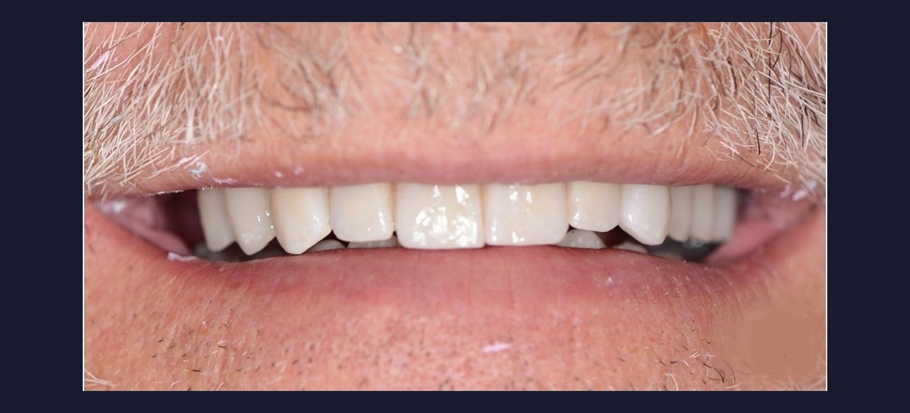 Full mouth reconstruction after
