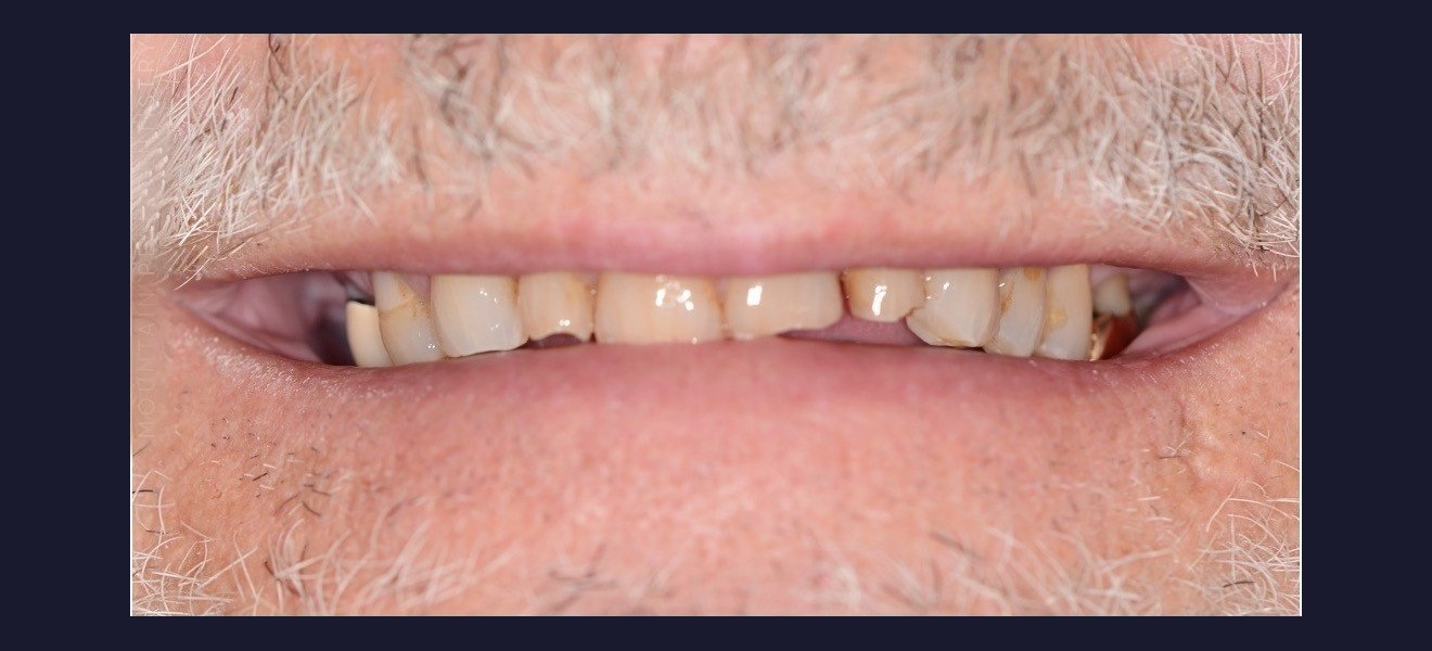 Full mouth reconstruction before
