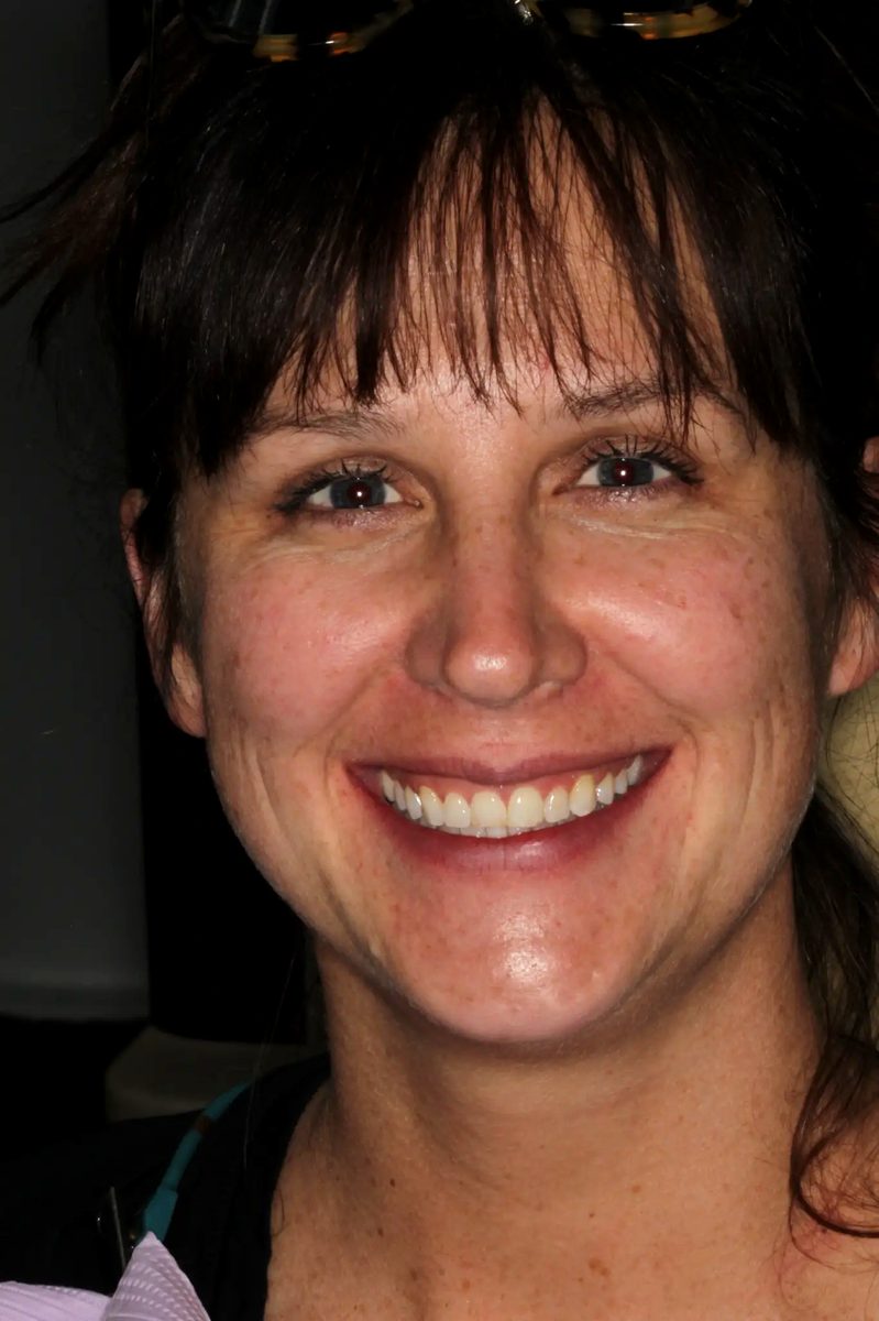Hannah's smile before porcelain veneers