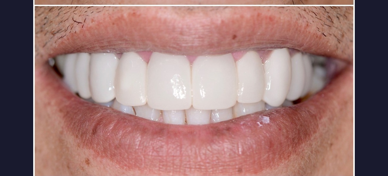 Full arch whitening after